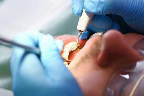 Best Emergency Root Canal Treatment in University Heights, OH